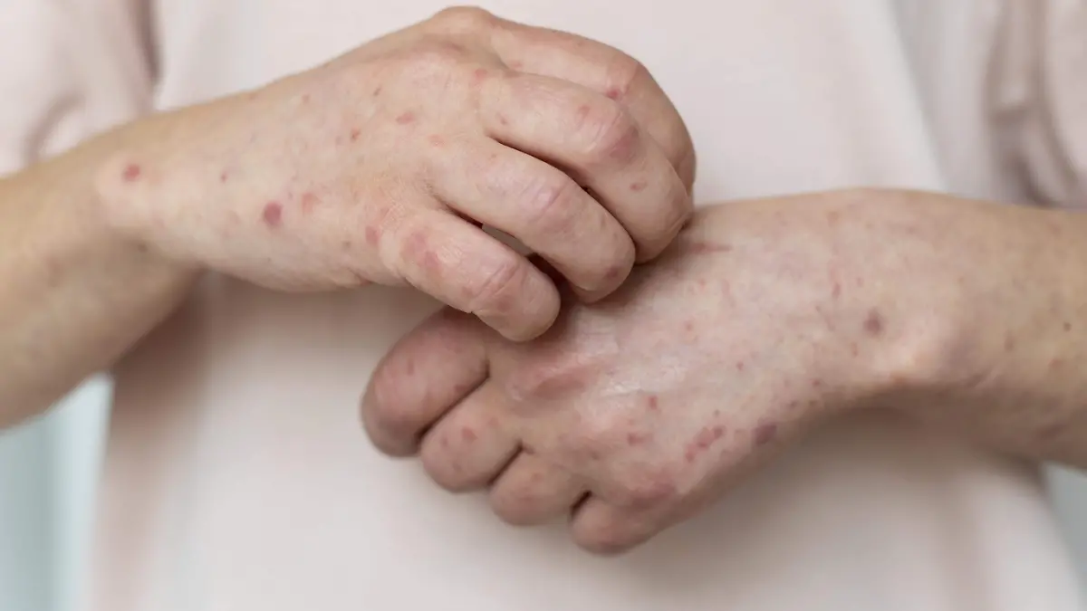 alergia-cutanea-en-el-brazo-de-una-persona
