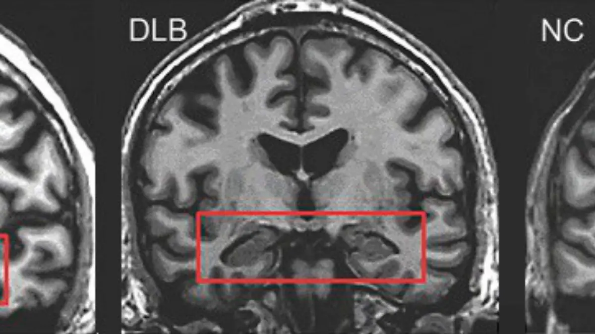 Diversas investigaciones señalan que el envejecimiento vuelve al cerebro más susceptible a los efectos tóxicos del alcohol.