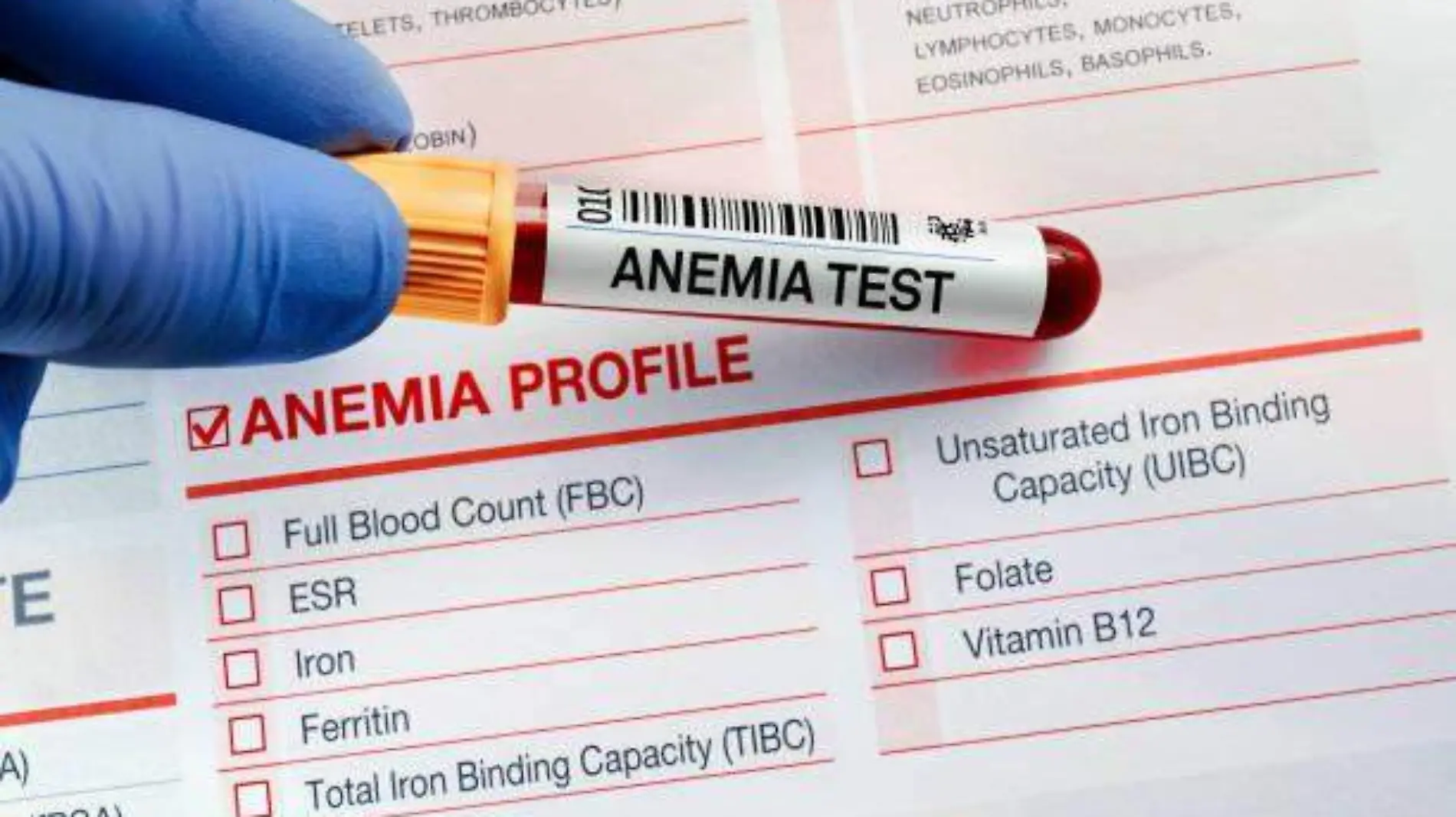 ANEMIA