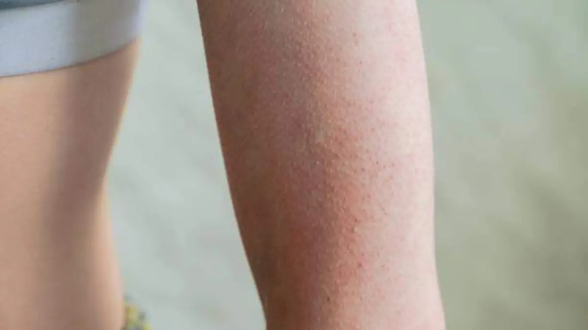 queratosis 