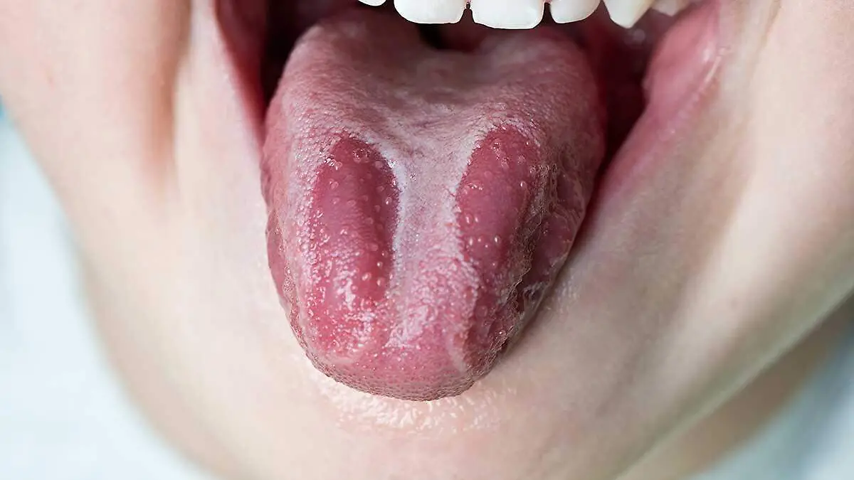glositis
