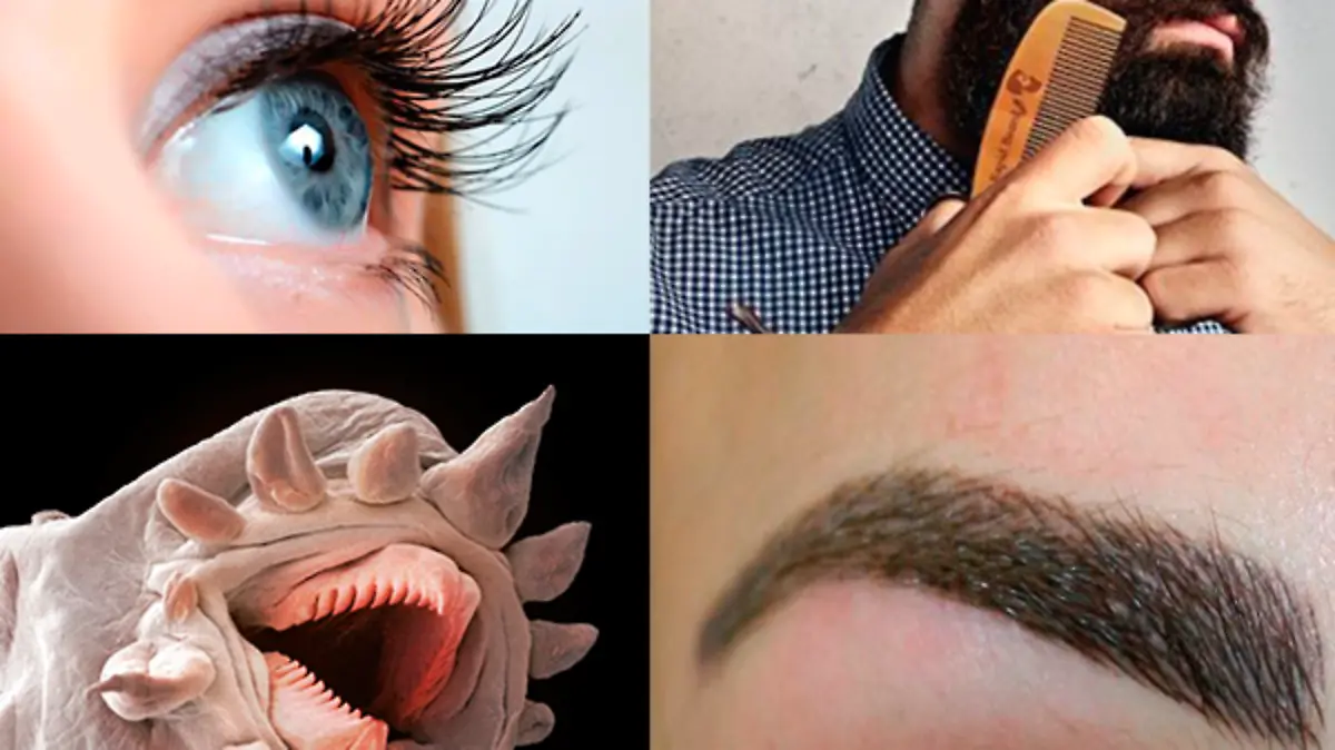 Foto 1 Se trata del ácaro Demodex Folliculorum, un ácaro microscópico que vive en el folículo del pelo de las pestañas, cejas o barba