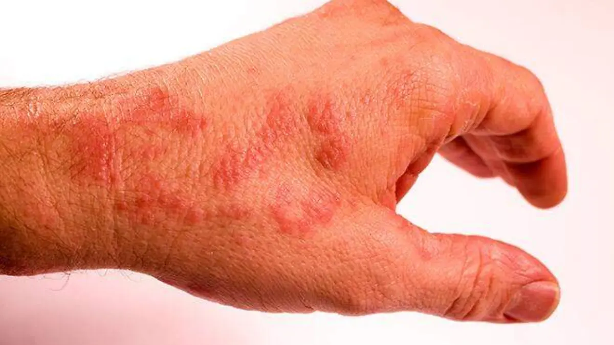 Foto 4 Alteraciones cutaneas