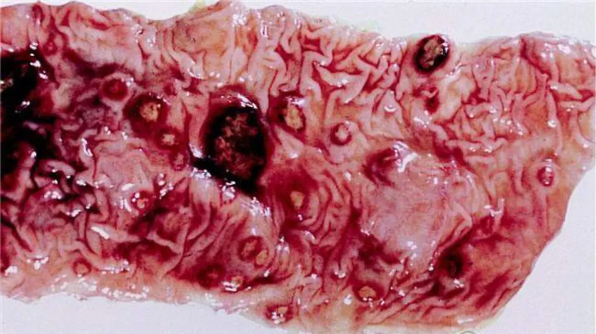 Foto 1 La amebiasis, es una infección intestinal causada por el parásito Entamoeba Histolytica