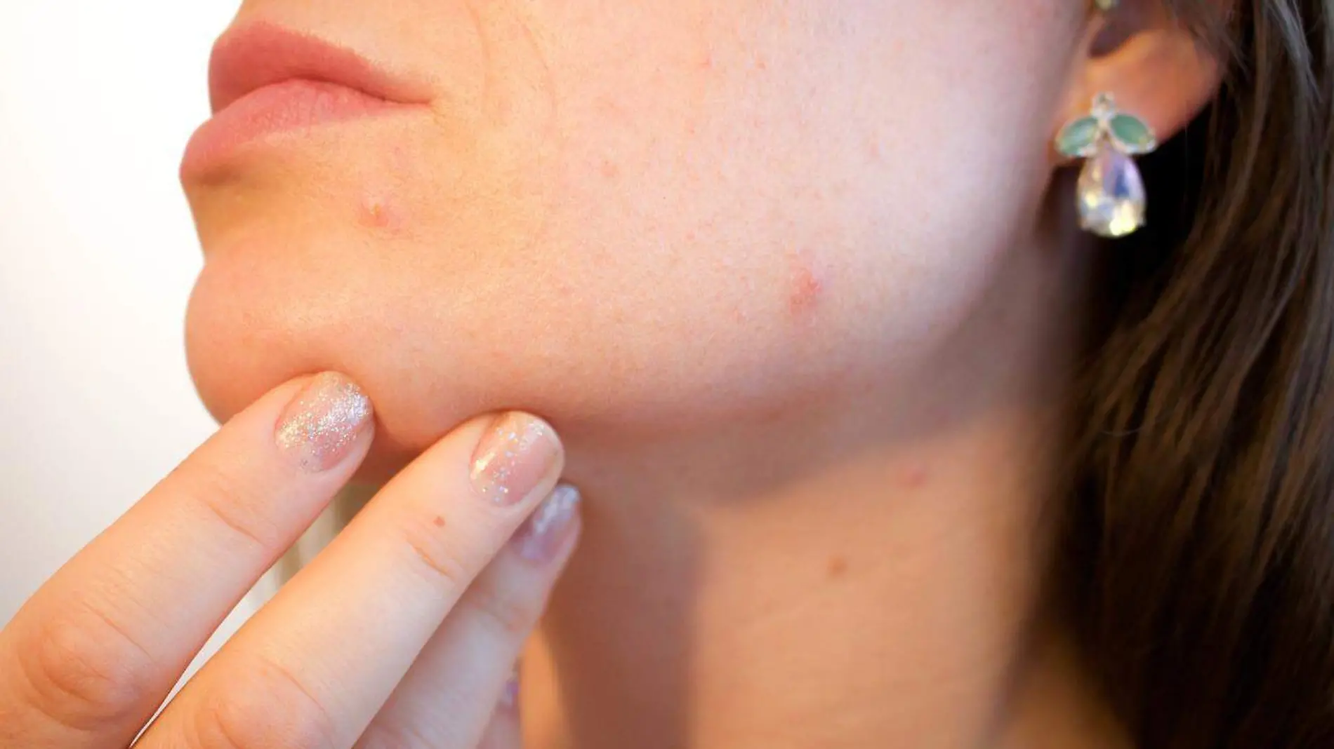 acne-gdc6a81f54_1280