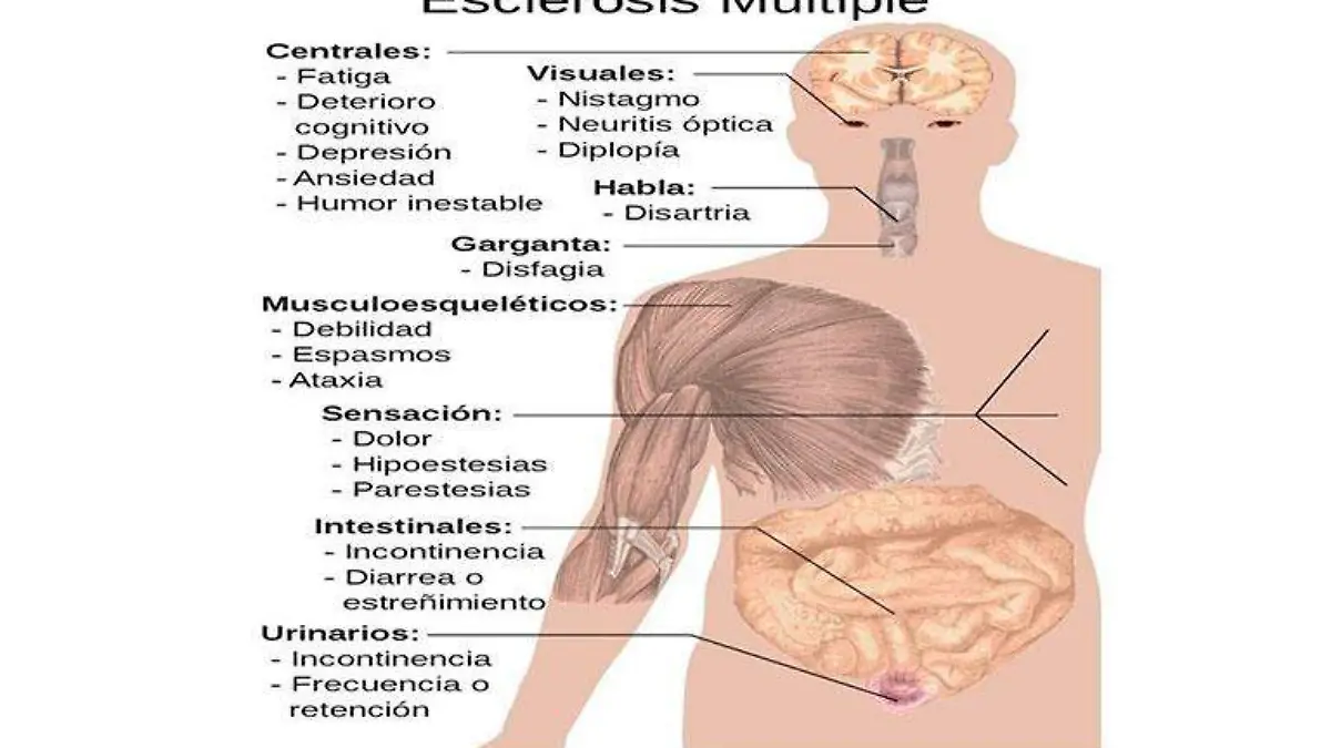 Esclerosis