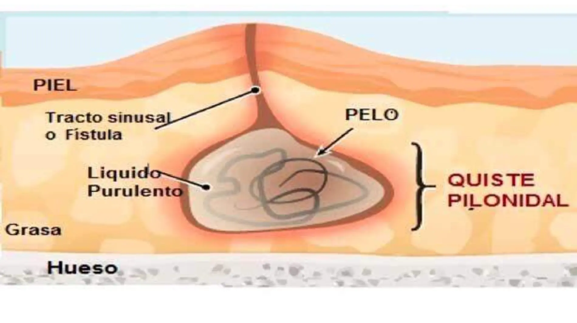 quiet-pilonidal