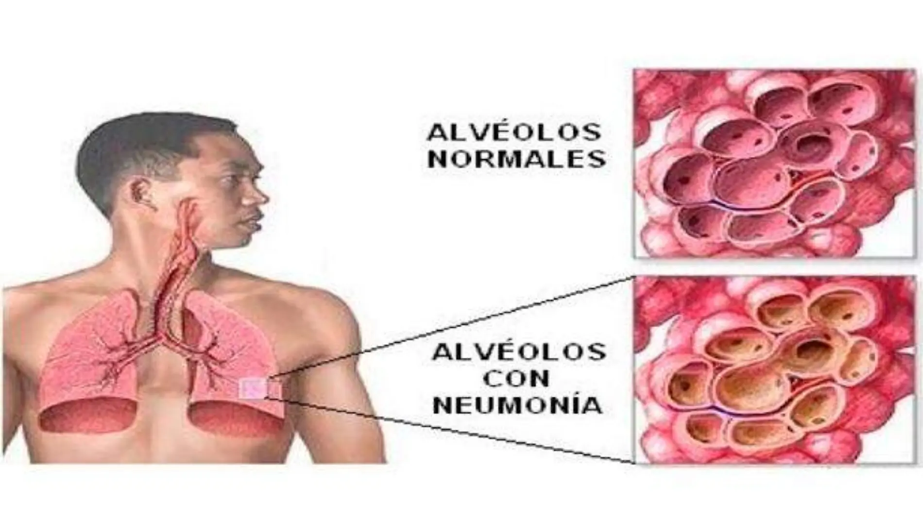 neumonia