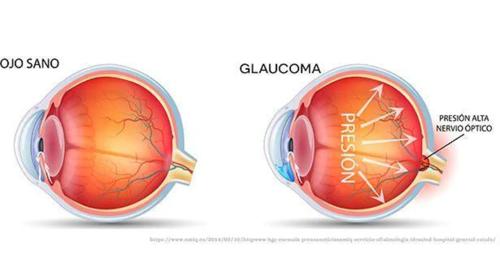 Glaucoma