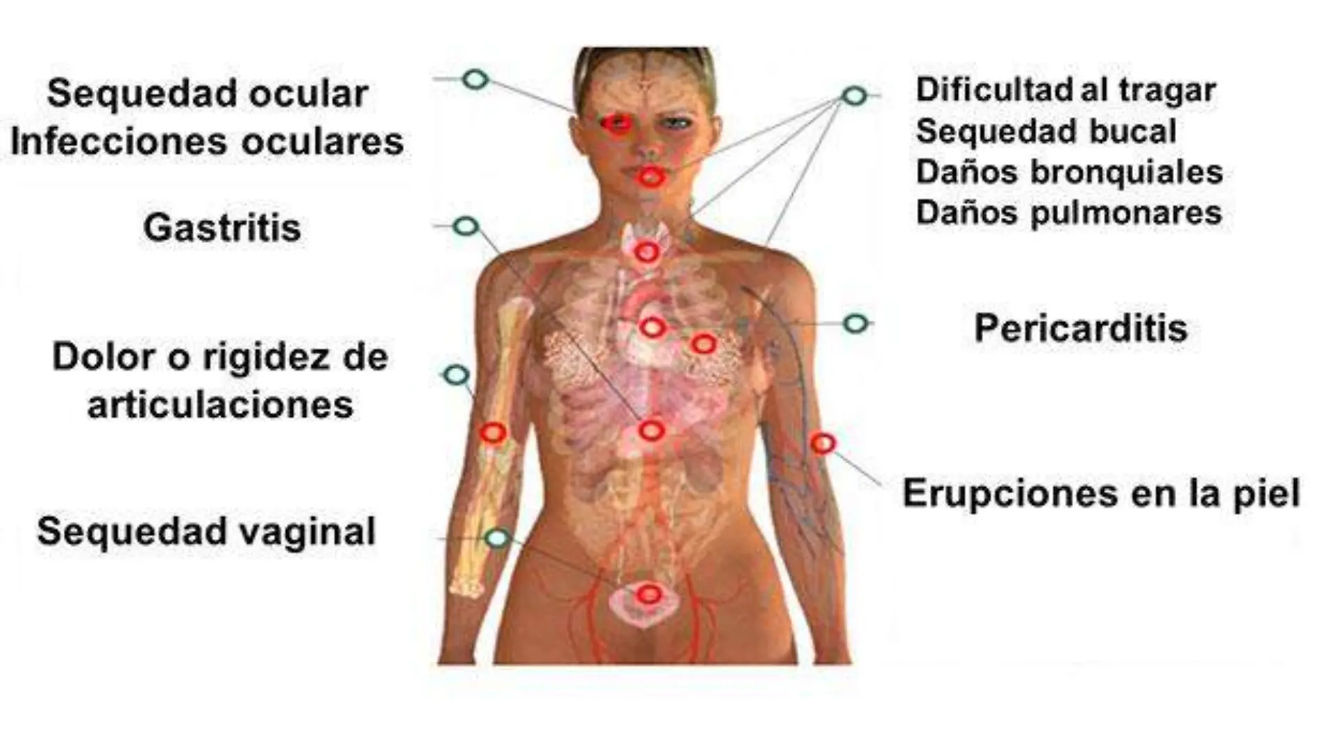 sindrome