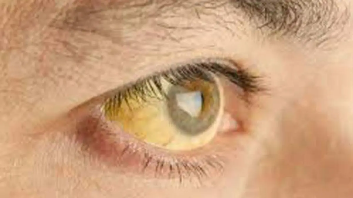 hepatitis1