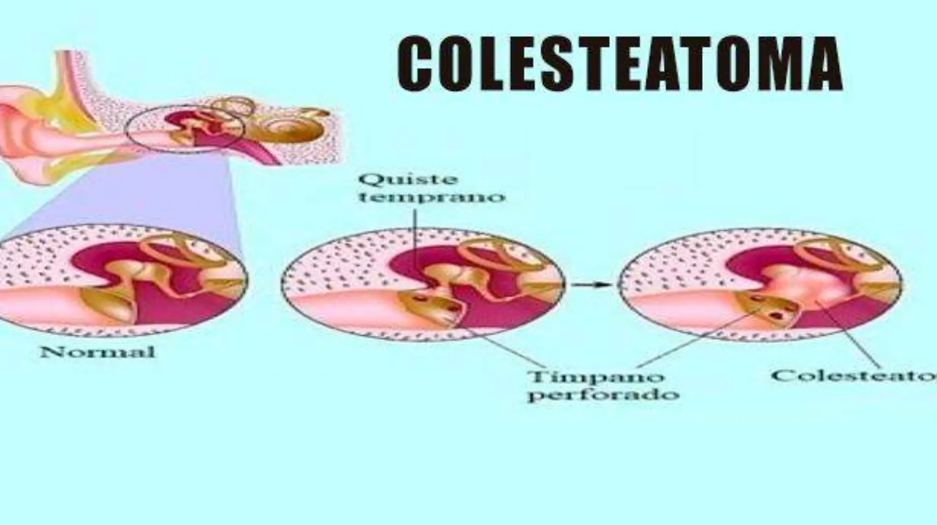 colesteatoma