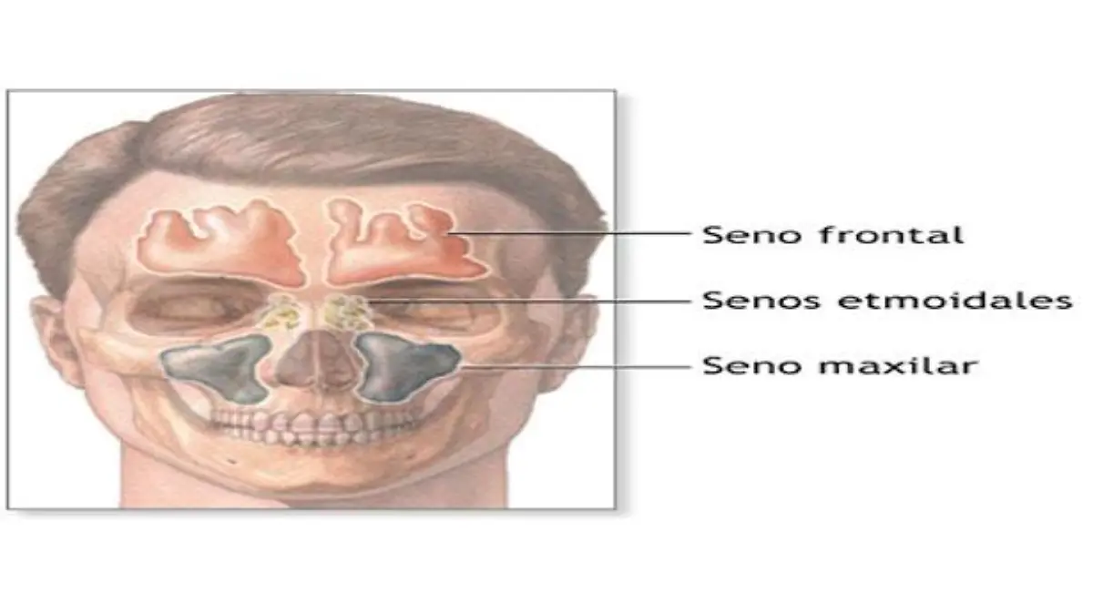 sinusitis
