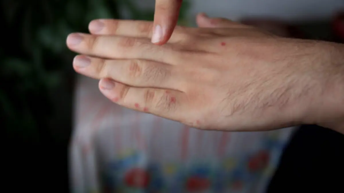 ¿Qué es la viruela del mono? 