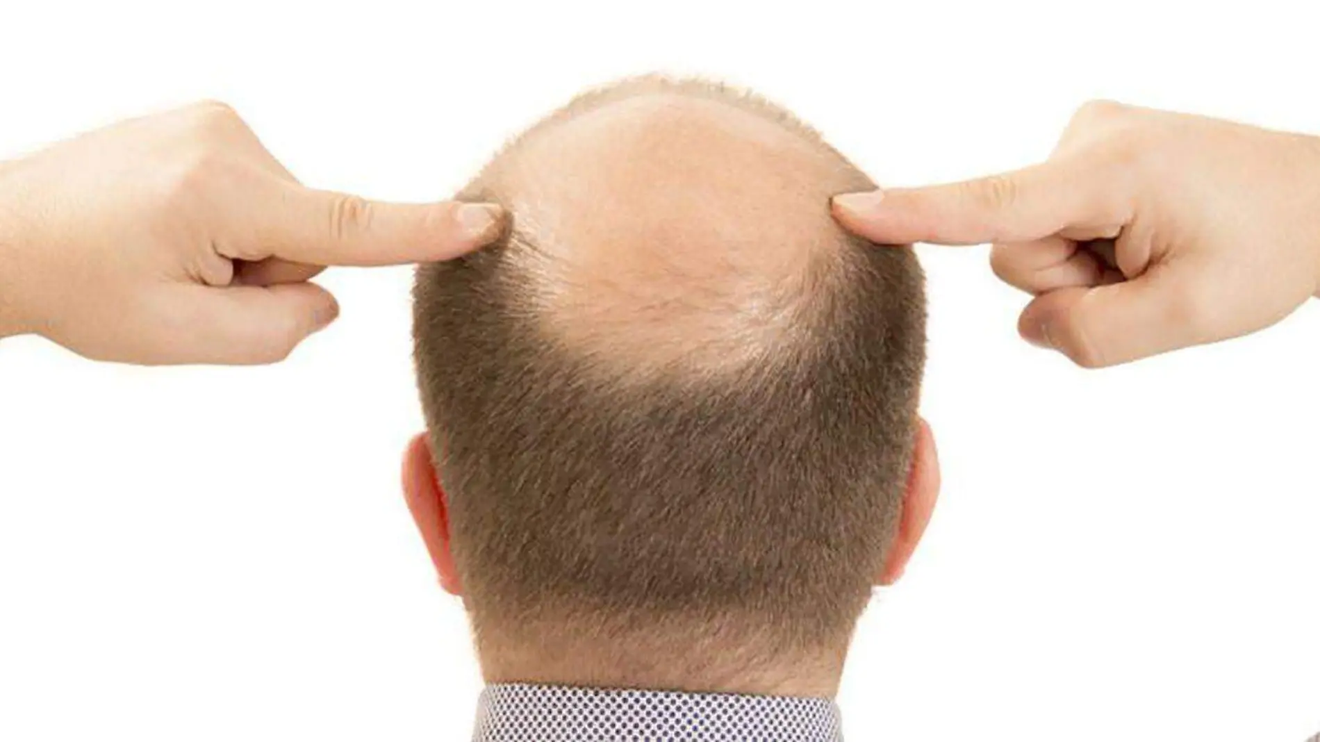 enfermedad-alopecia-hombre-cabello_0