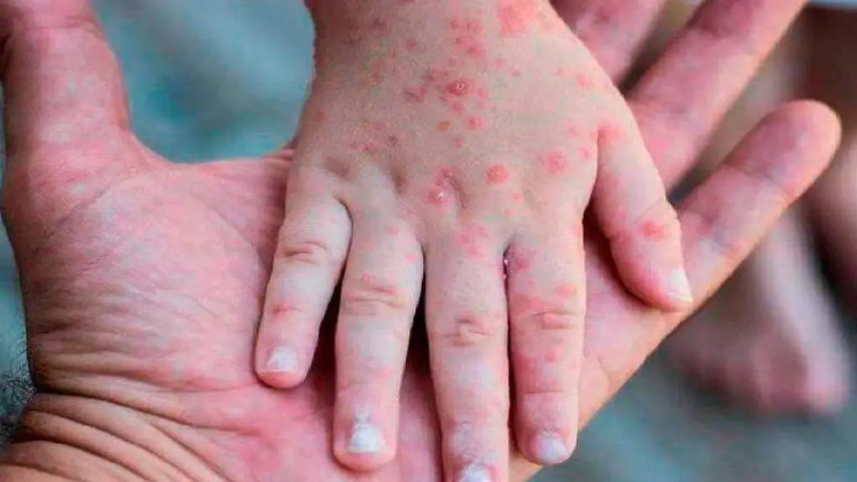 viruela del mono contagio