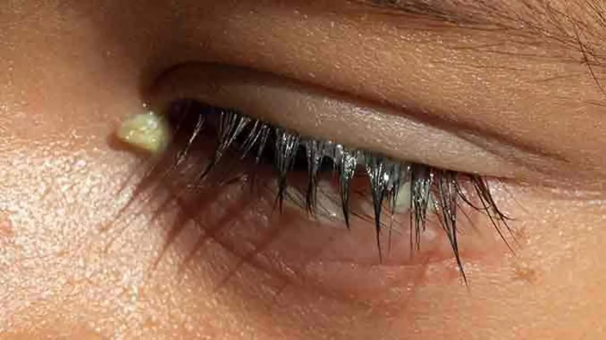 Hero_Article_Eye_Discharge_678x446