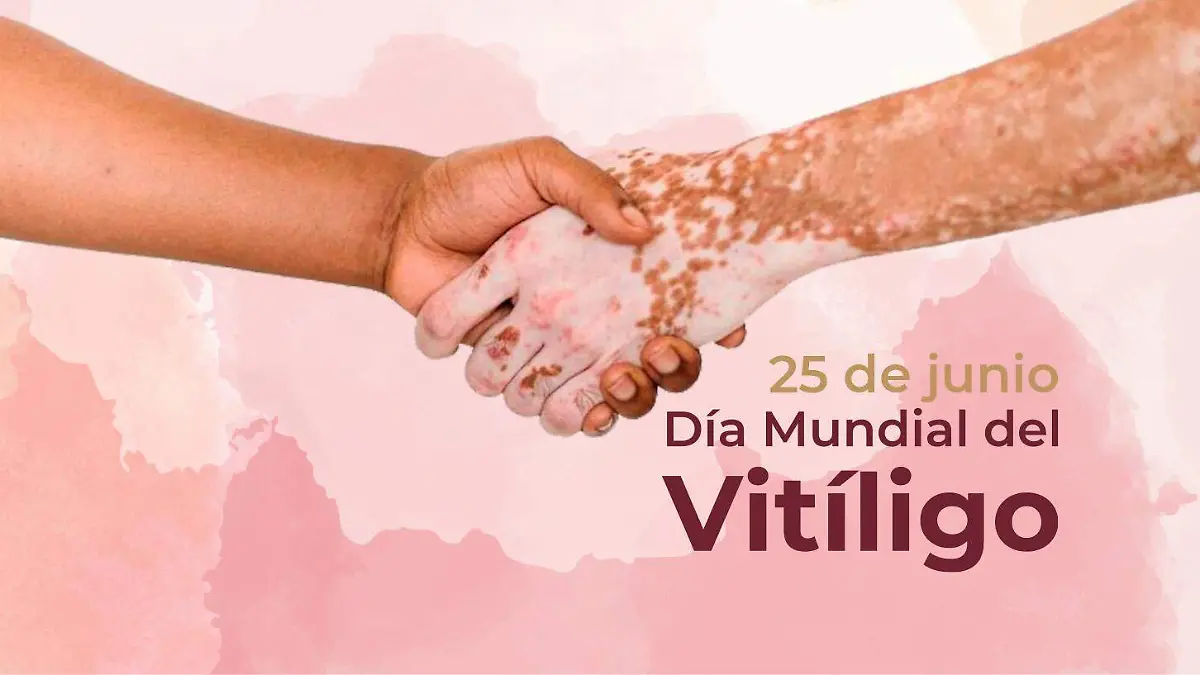 Día Mundial del Vitiligo