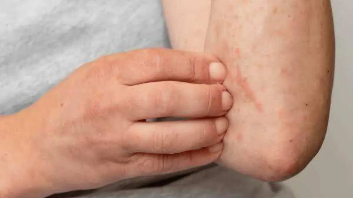 Sarna piel Chiapas enfermedades