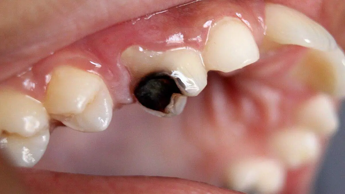 Dental_Caries_Cavity_2