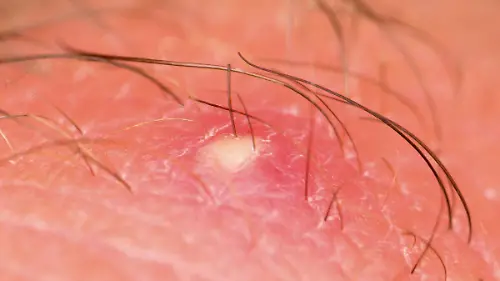 Vellos-encarnados-Como-prevenir-los-pelos-enquistados