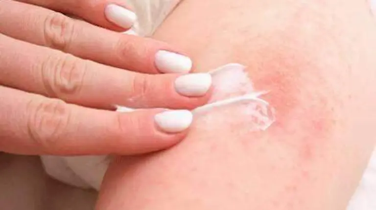 Tratamiento_dermatitis_Pañal_Articulos_Relacionados