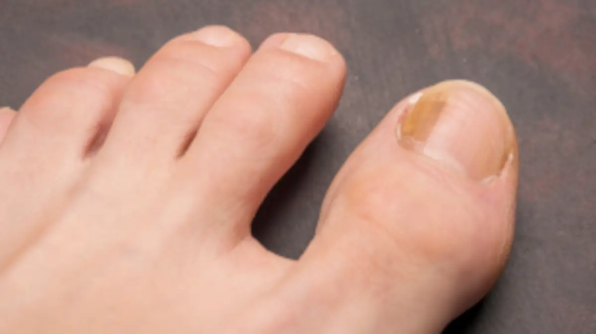 onicomicosis