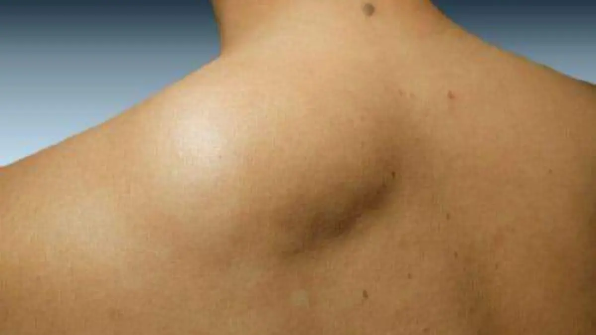 lipoma