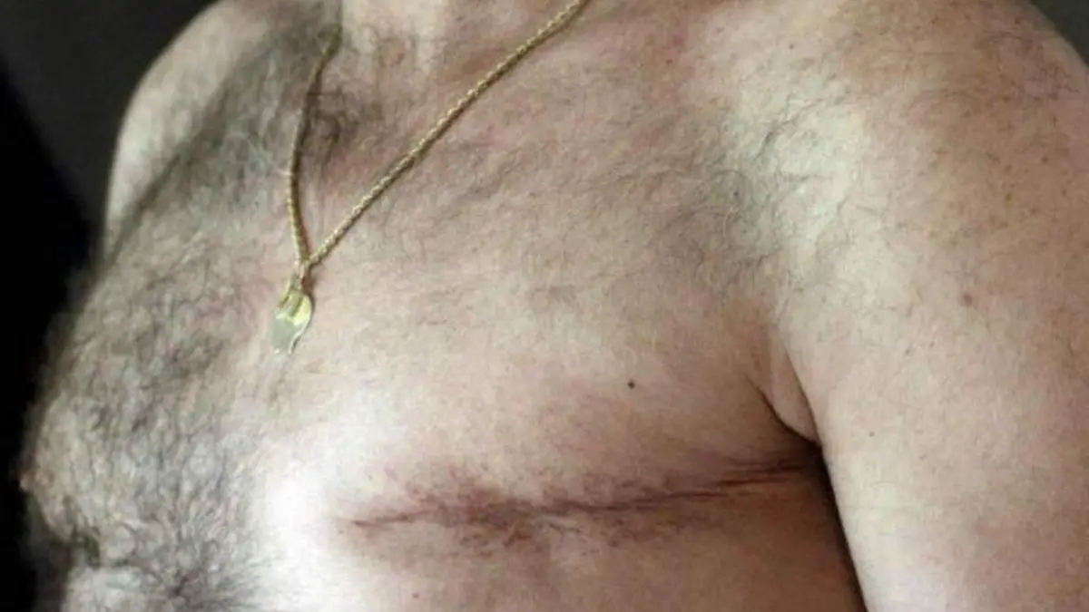 cáncer de mama hombre