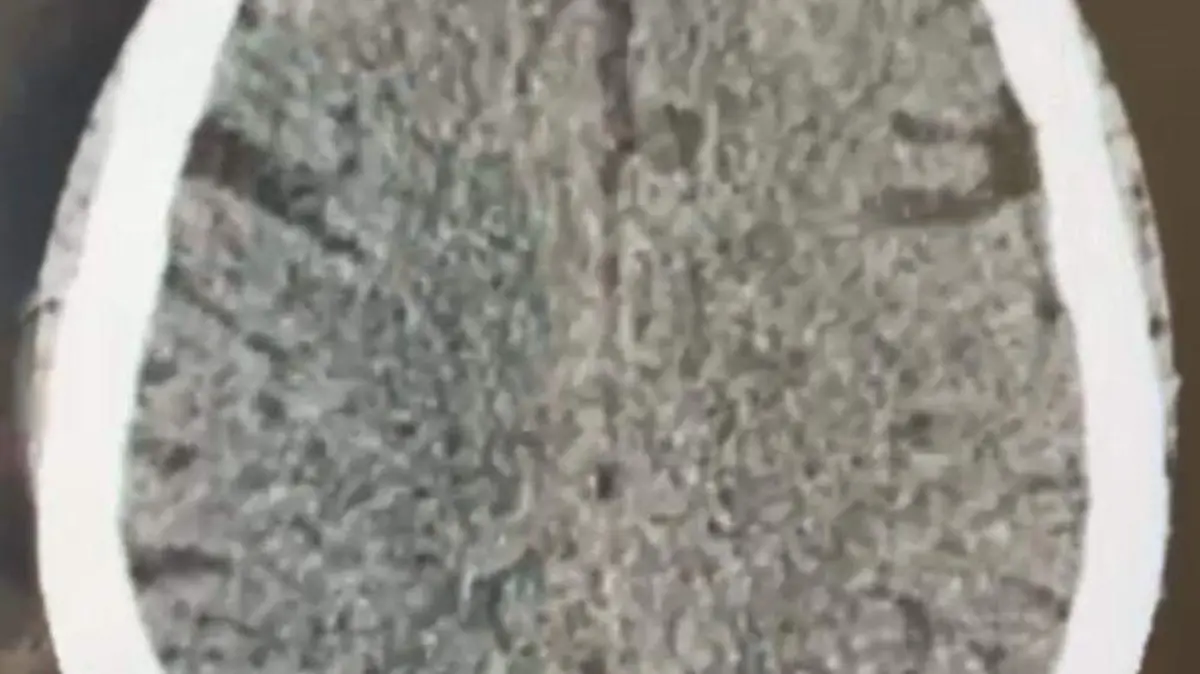 rescate cerebral a paciente con embolia