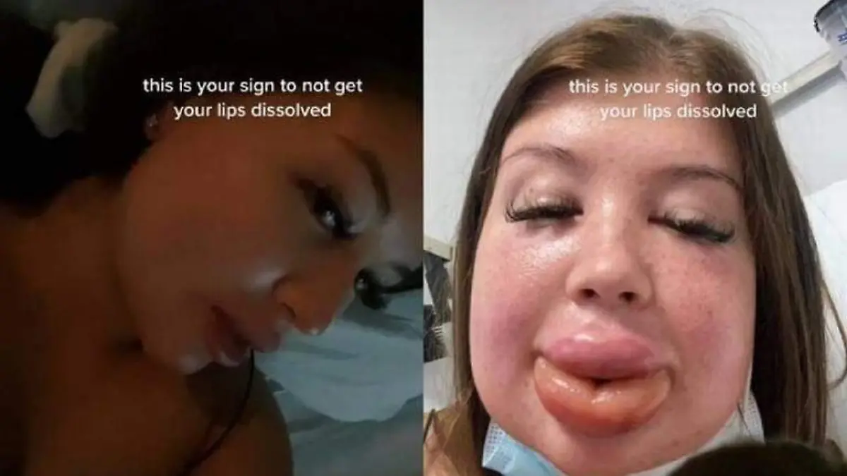 Karli Garden, una joven de Reino Unido buscaba tener unos labios hermosos, sin embargo, el resultado fue muy diferente al que ella esperaba:Foto-Captura de pantalla | TikTok @karligarhnerxx