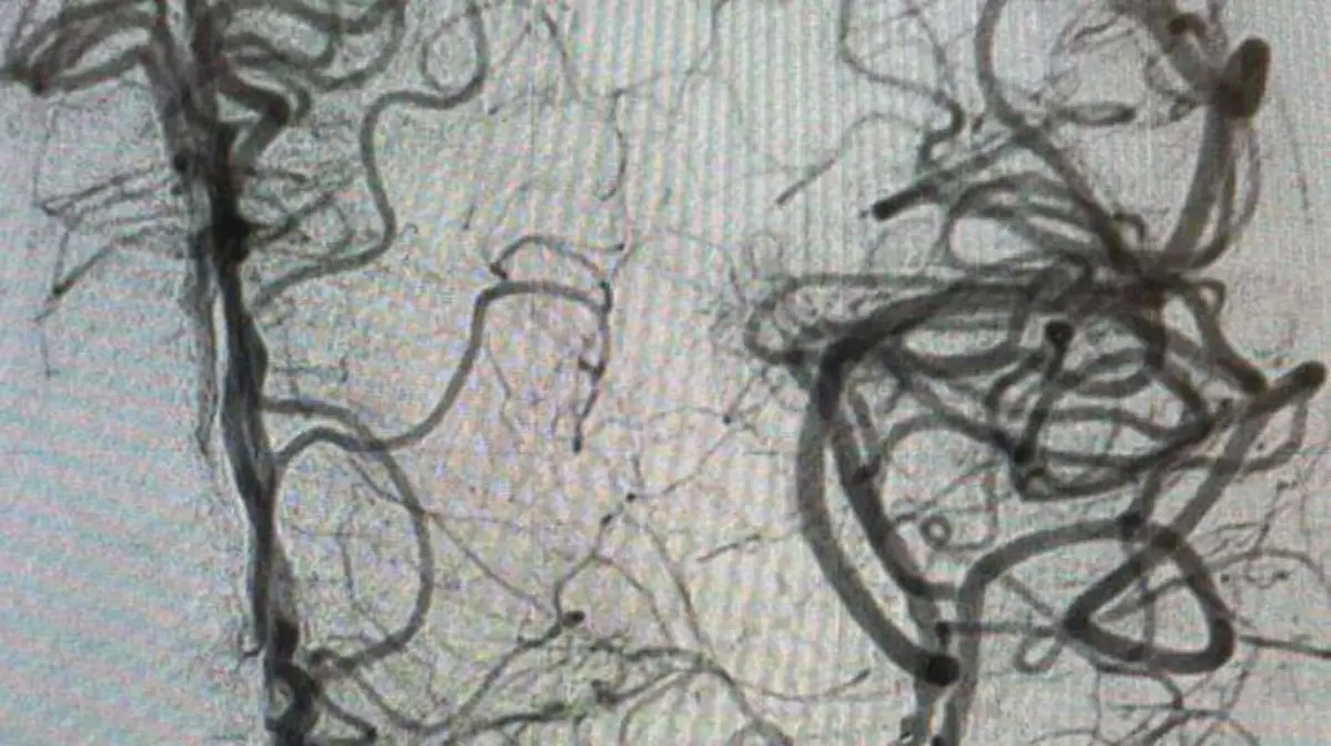 rescate cerebral a paciente con embolia