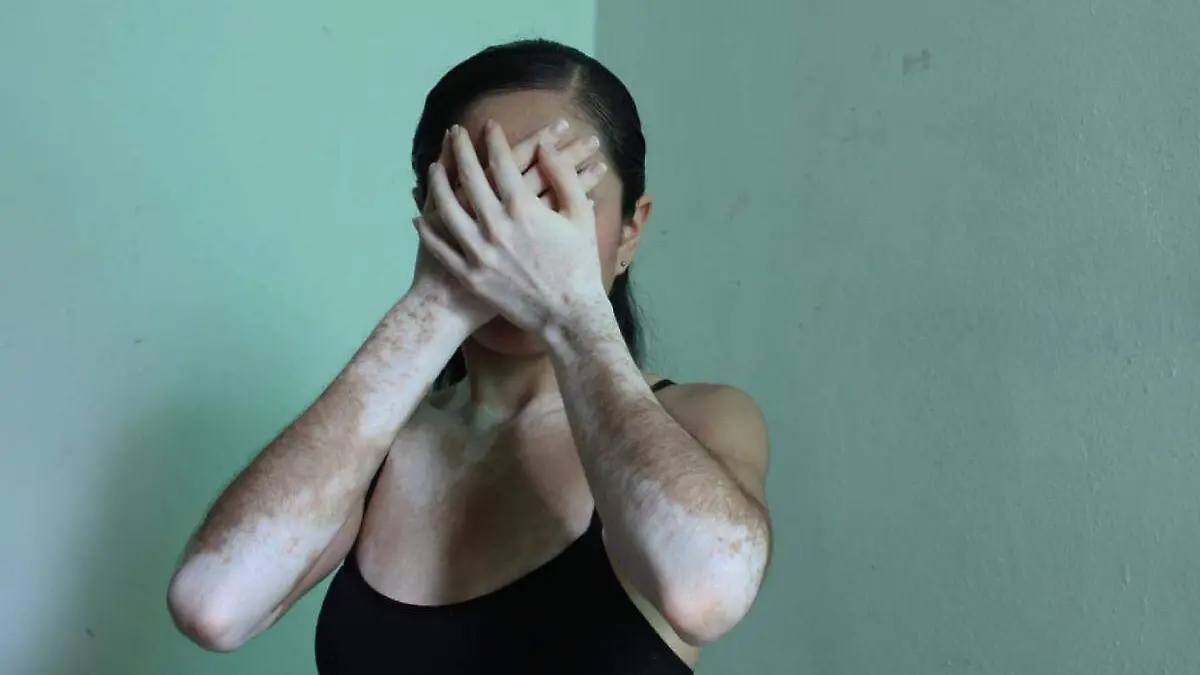 vitiligo (2)