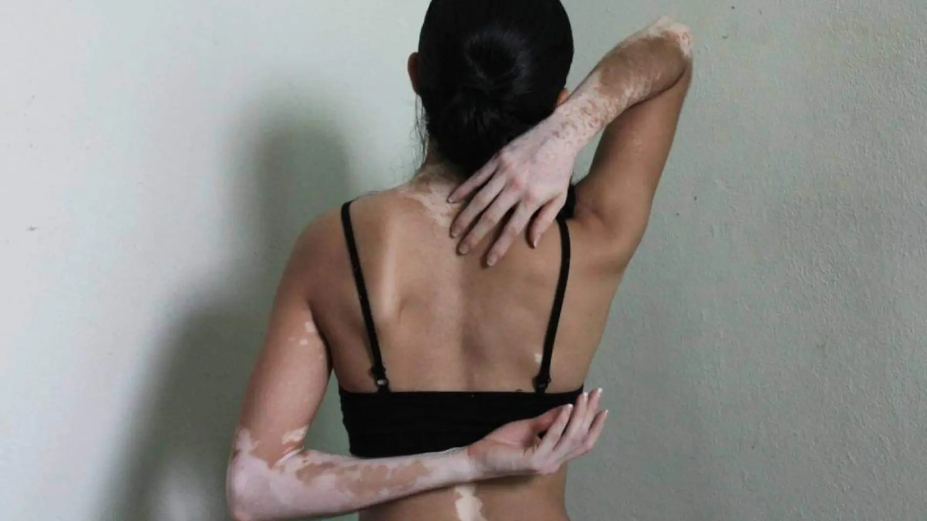 Vitiligo