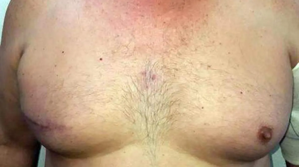 cancer1