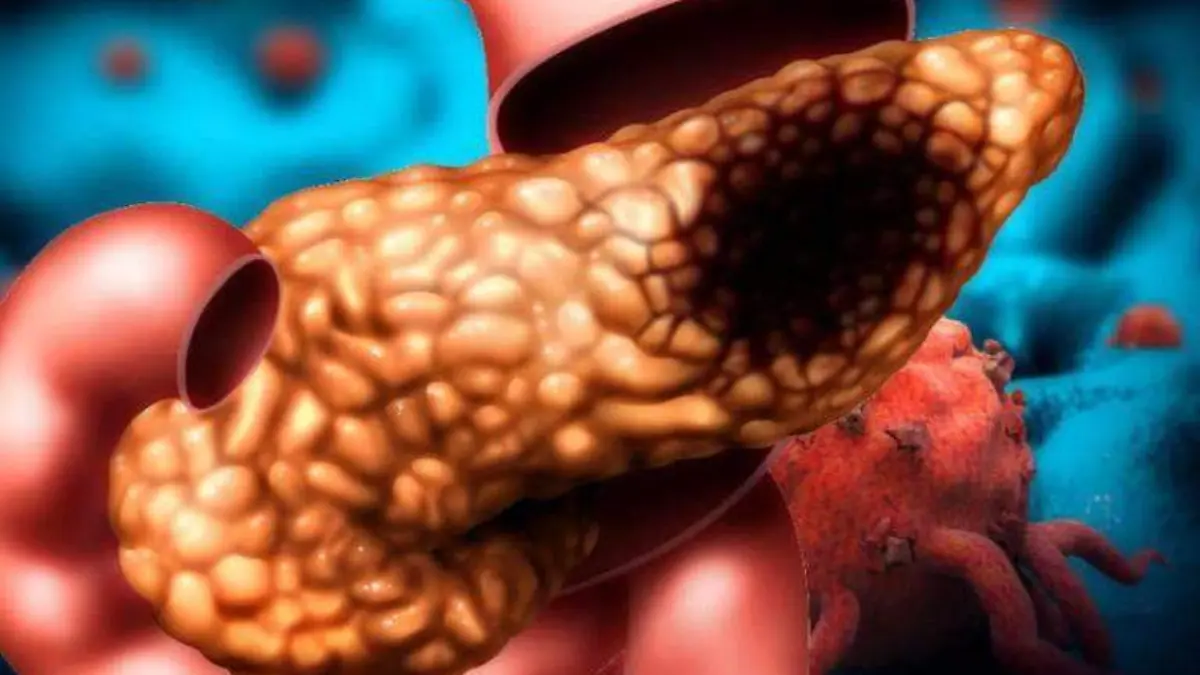 cáncer pancreas OEM