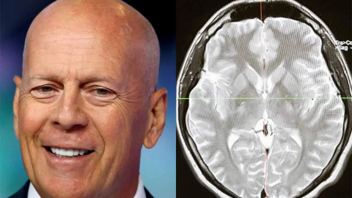 Bruce Willis y su demencia
