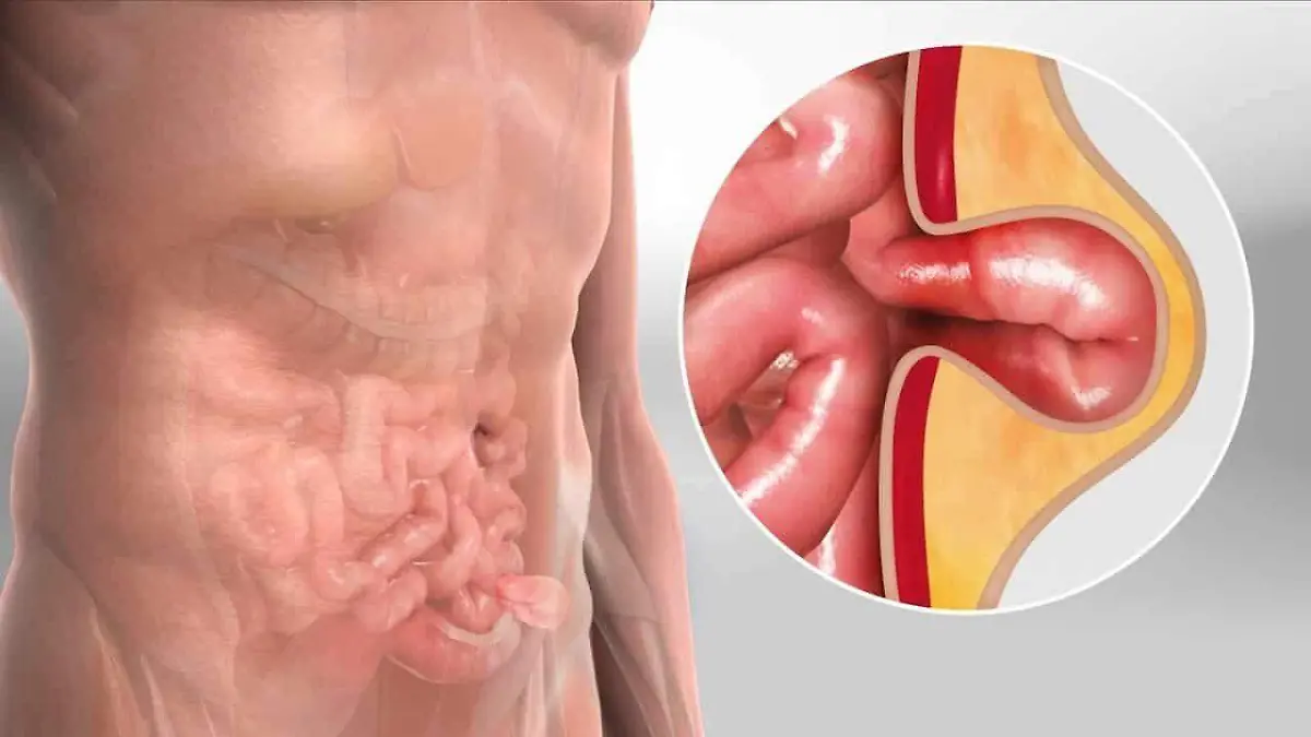 operar-hernia-inguinal