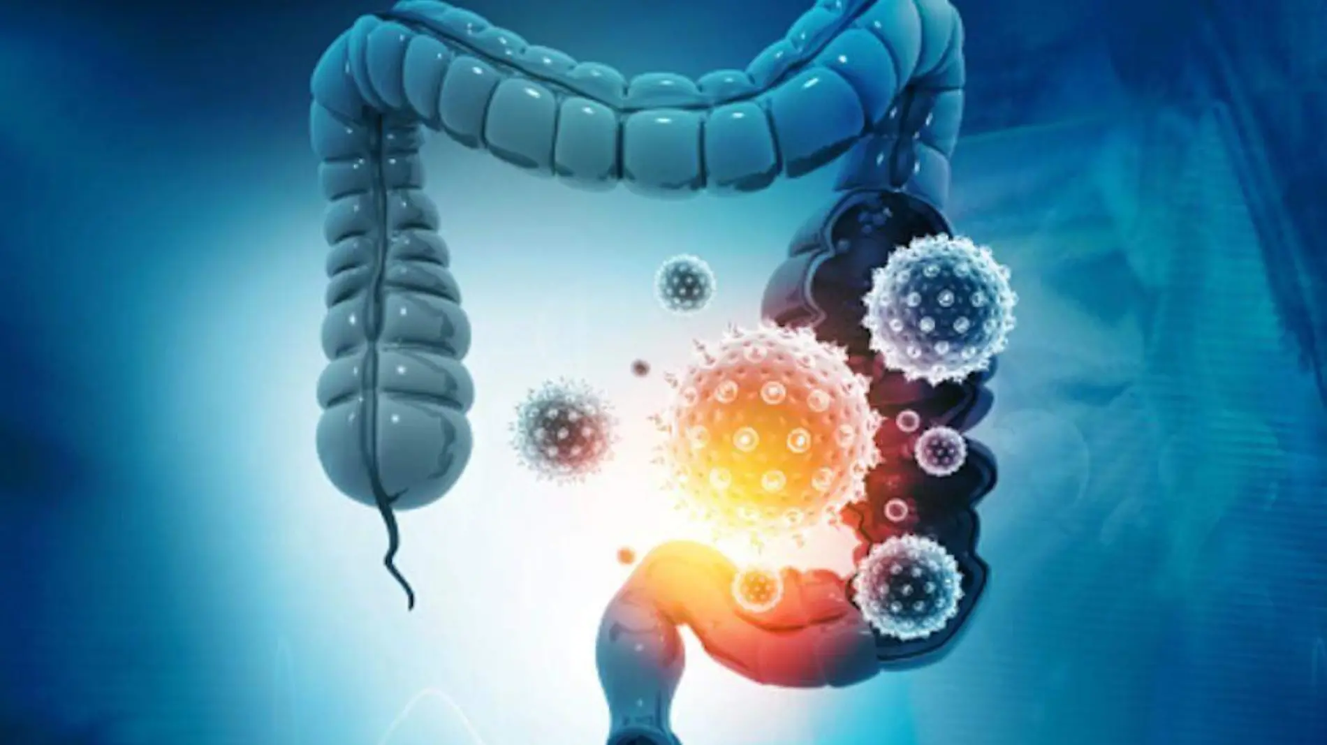 enfermedades-inflamatorias-intestinales