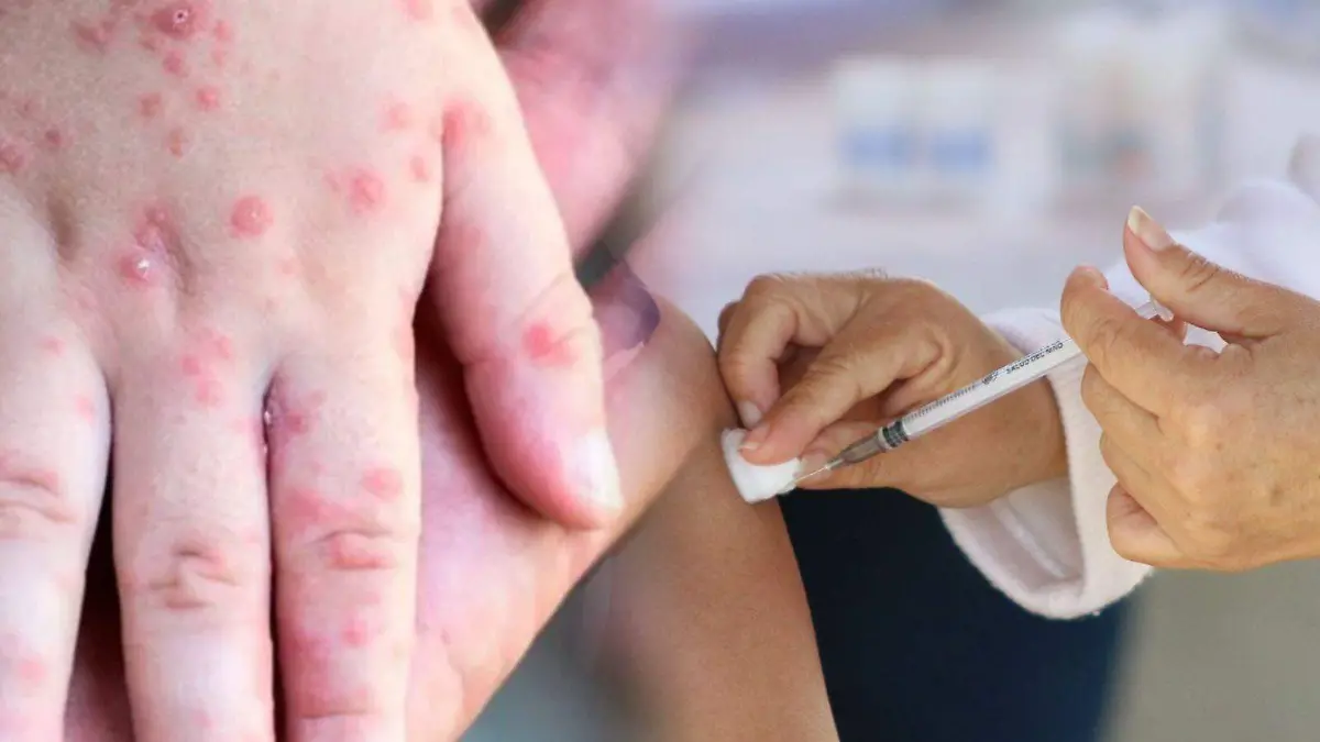 Sarampión Coxsackie