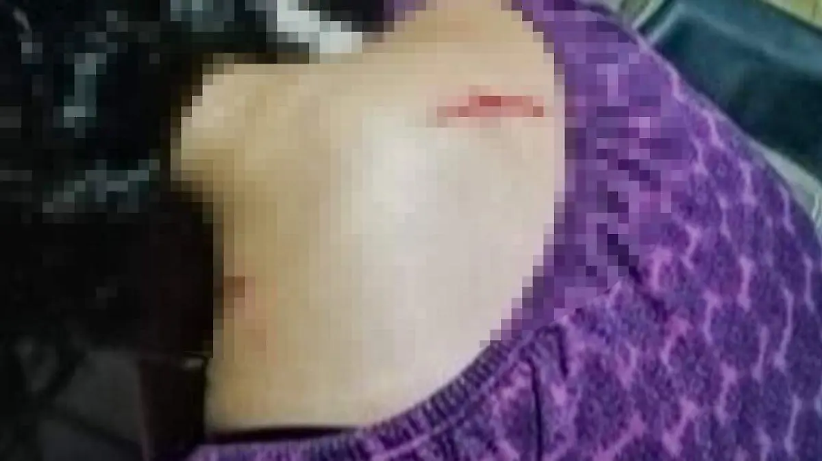 lesionada