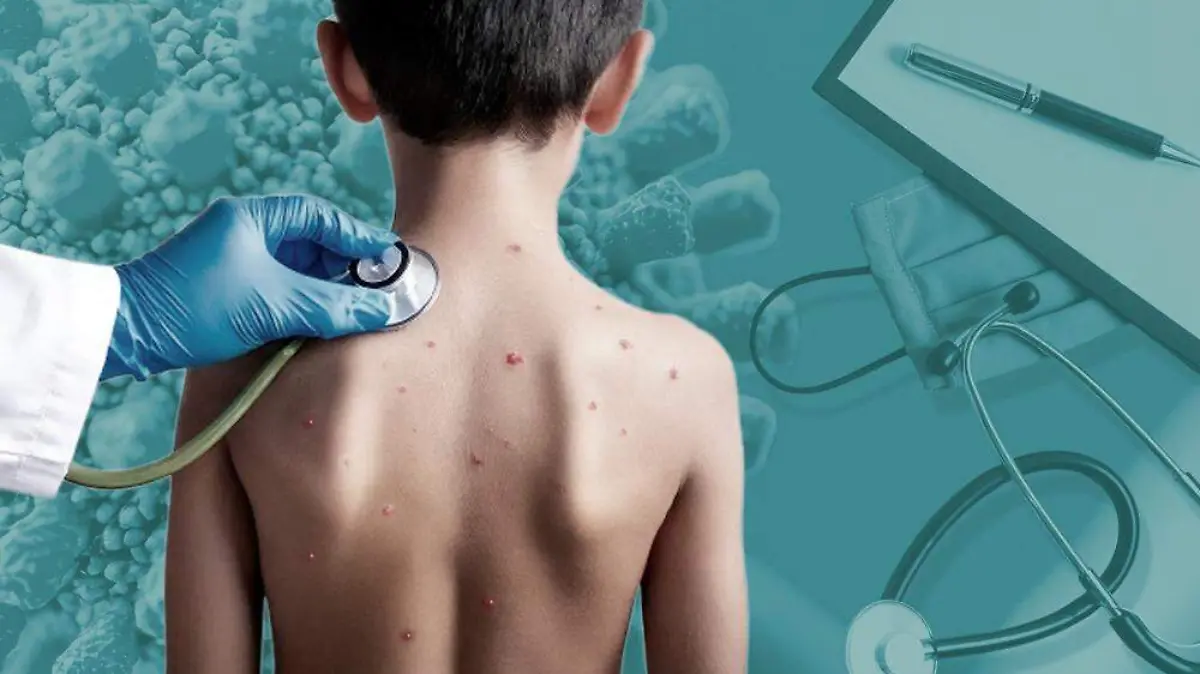 Actualizacion-Sarampion-Personal-medico1