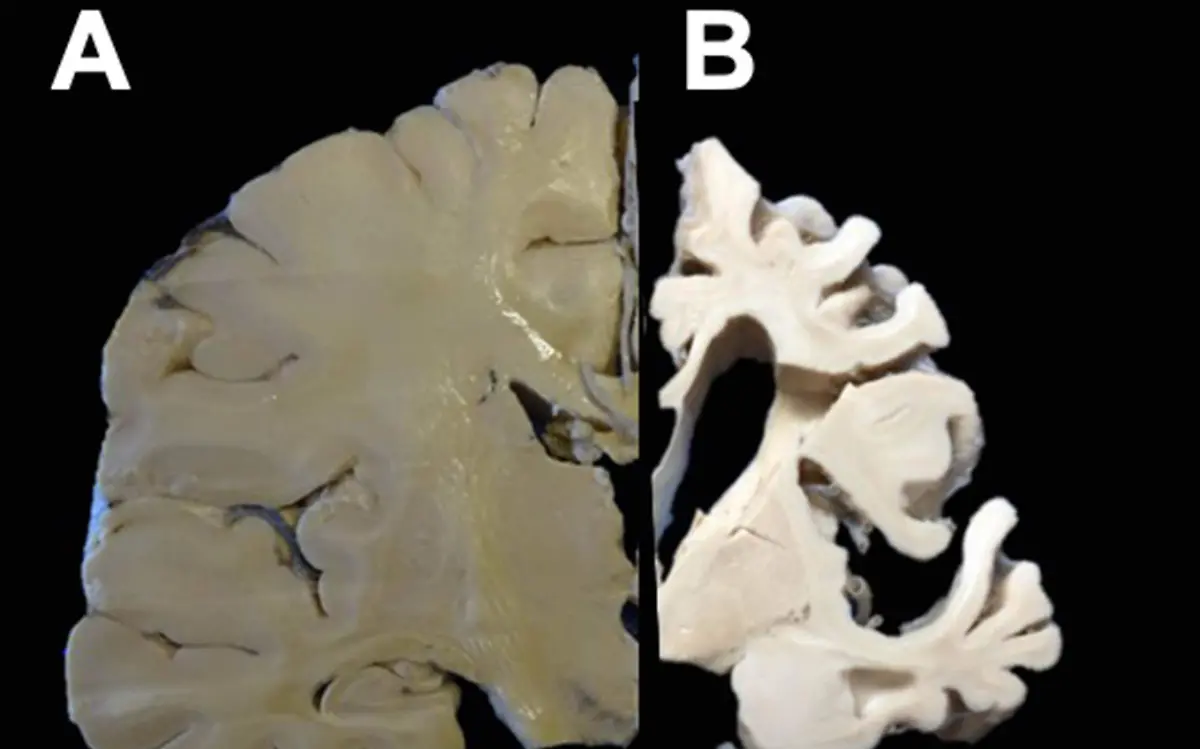 Se analizarán los encéfalos y fragmentos de órganos de individuos que padecieron algún tipo de demencia.