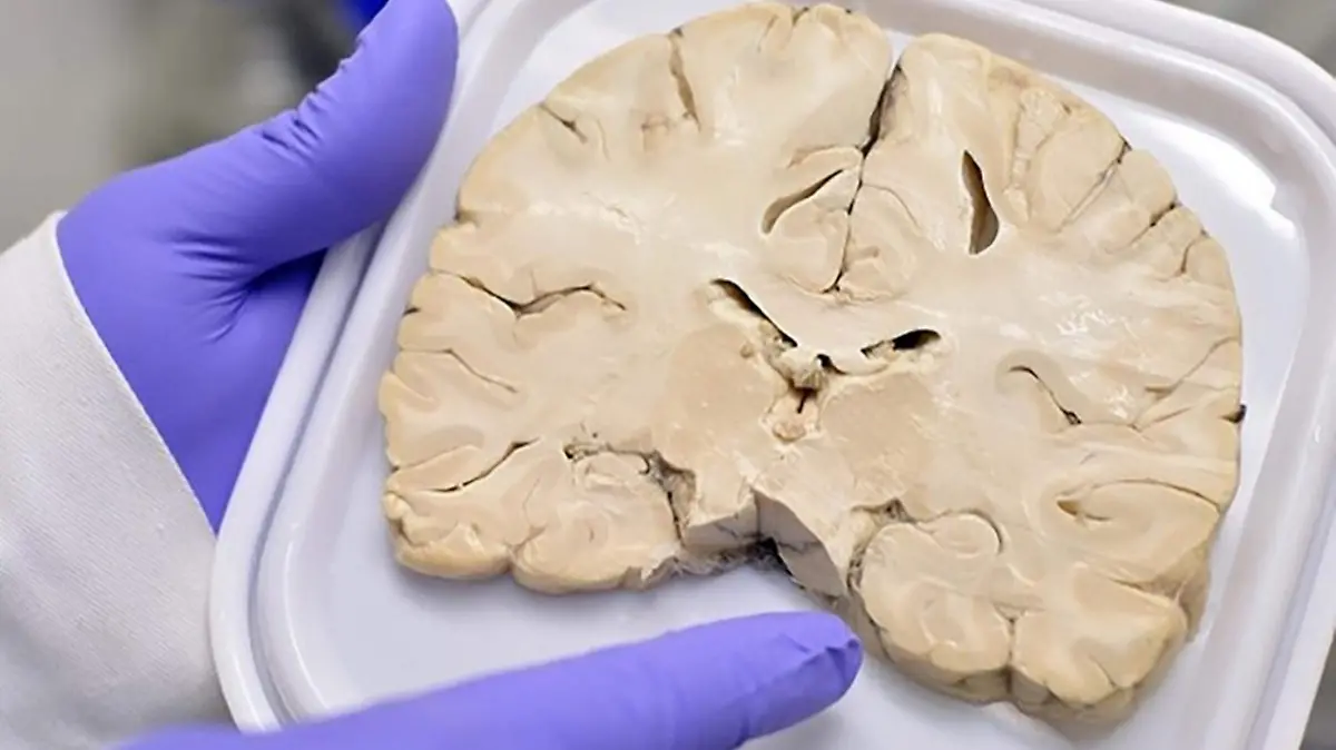 Esta clase de padecimientos con origen desconocido al momento y su fehaciente determinación, sólo puede realizarse post mortem.