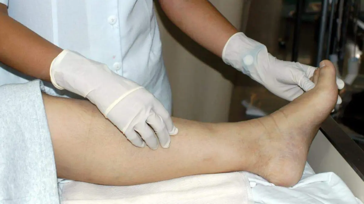 hemofilia IMSS Morelos (1)