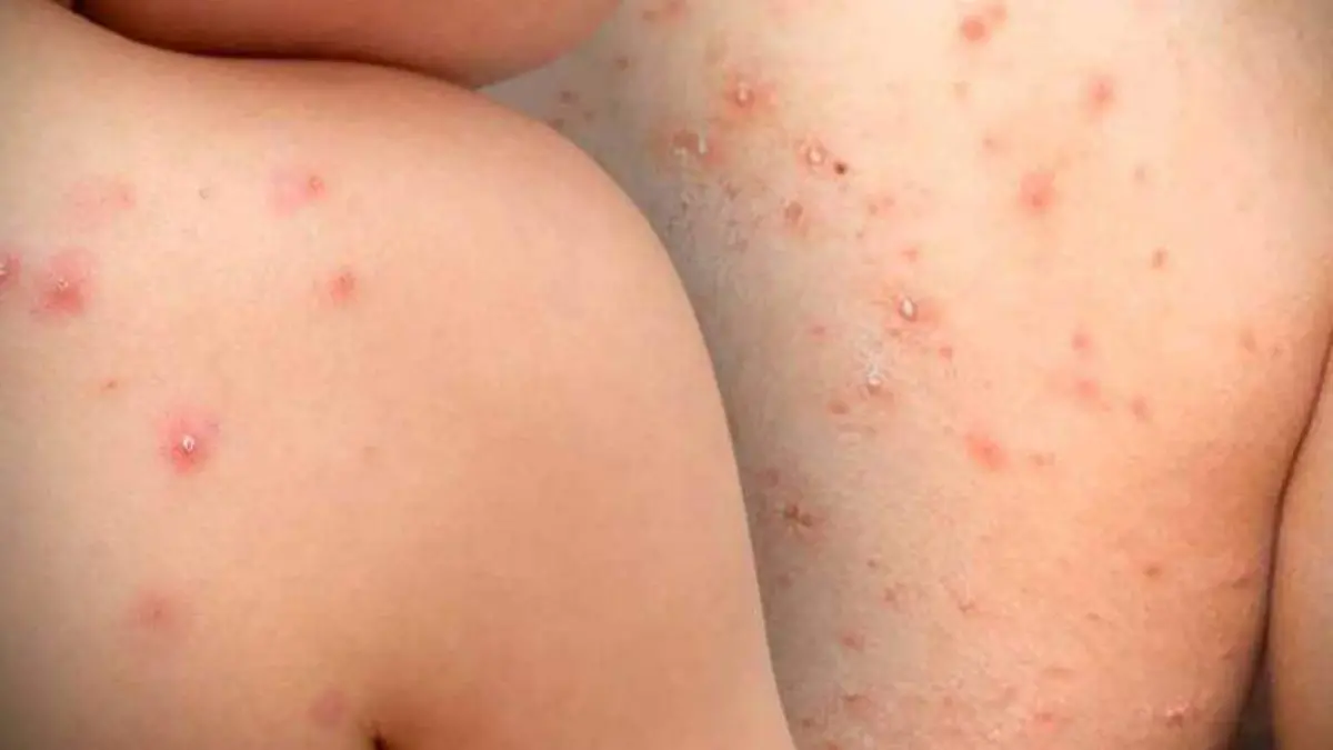 viruela-del-mono-archivo