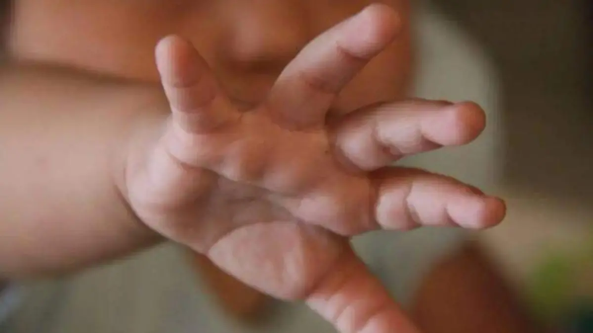 Mientras su madre se preparaba un café, bebé se arroja accidentalmente agua hirviendo