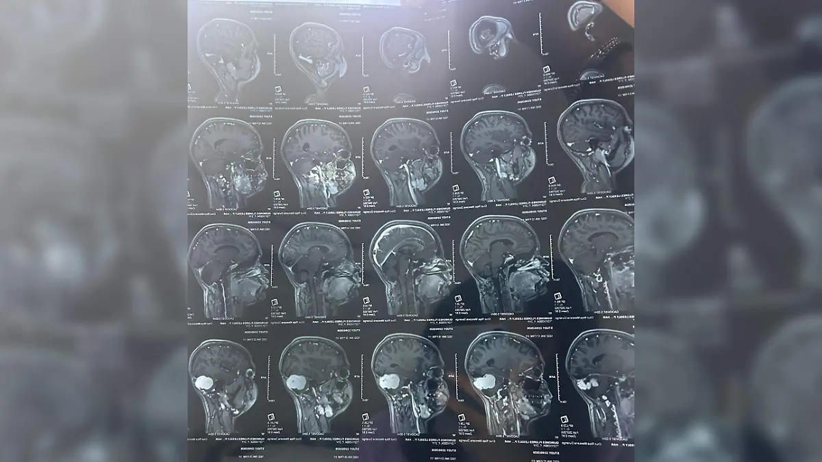 Lanzan colecta para ayudar a Lessly Paola; tiene un tumor cerebral