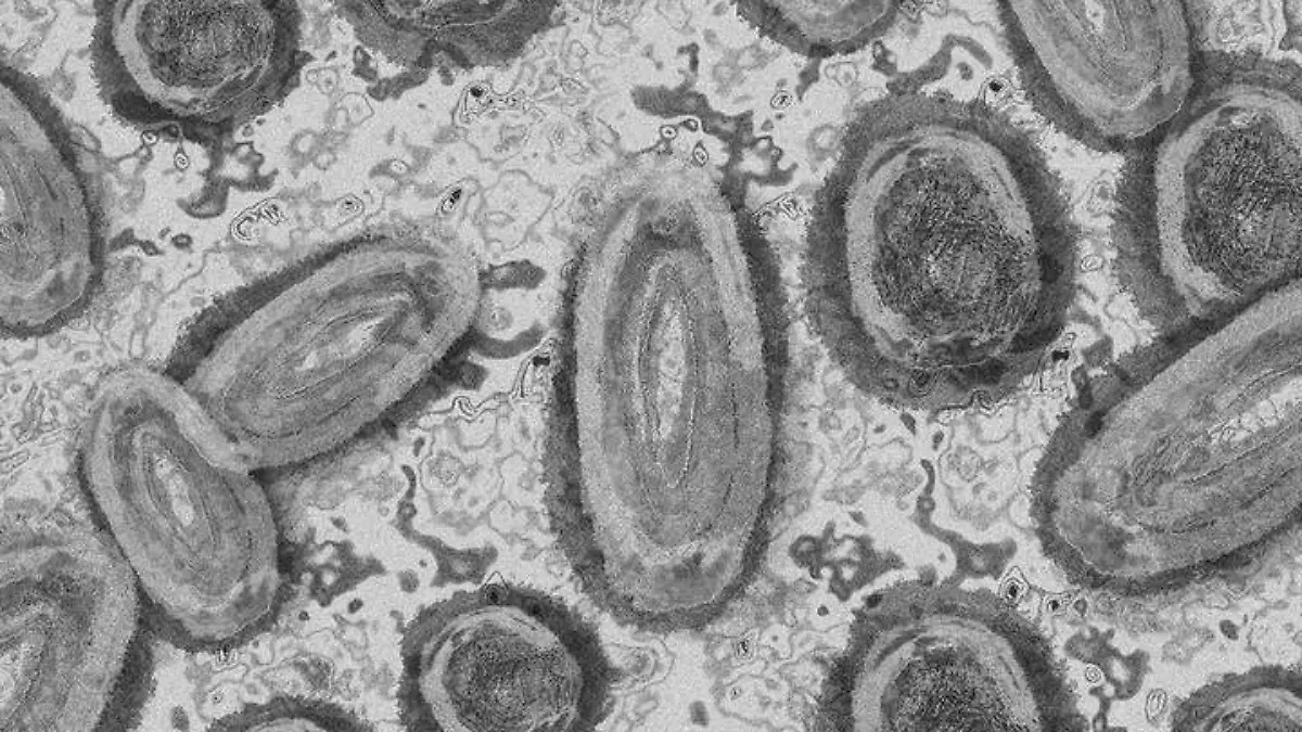 Viruela del Mono se transmite por sexo