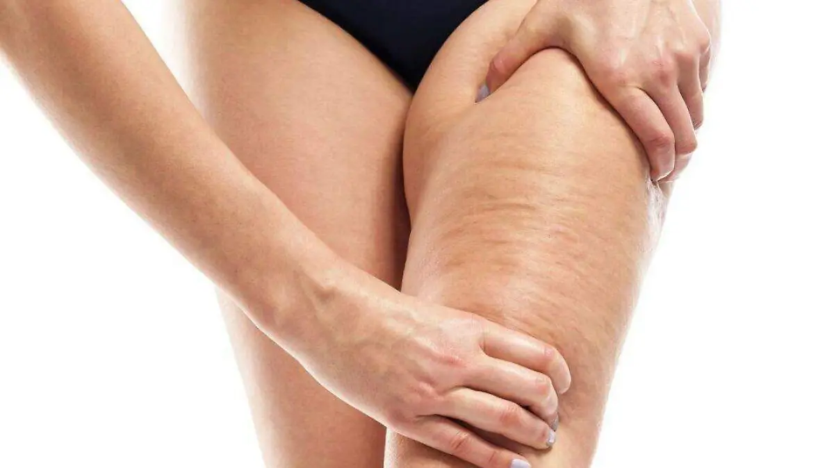 Celulitis o Piel de naranja